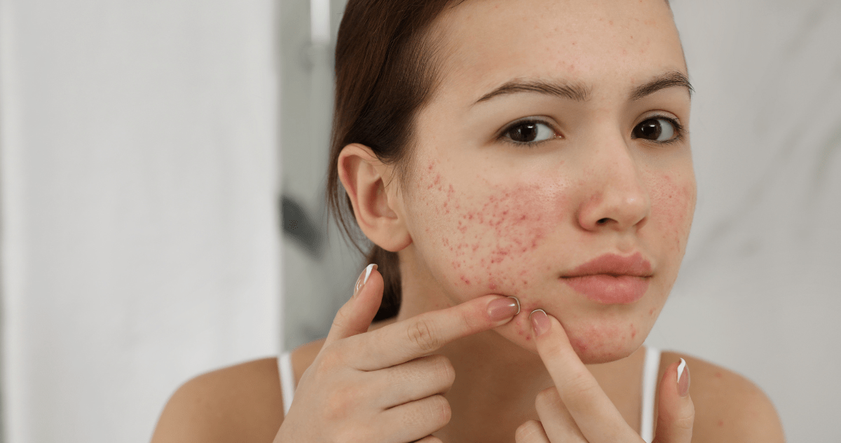 CBD for acne